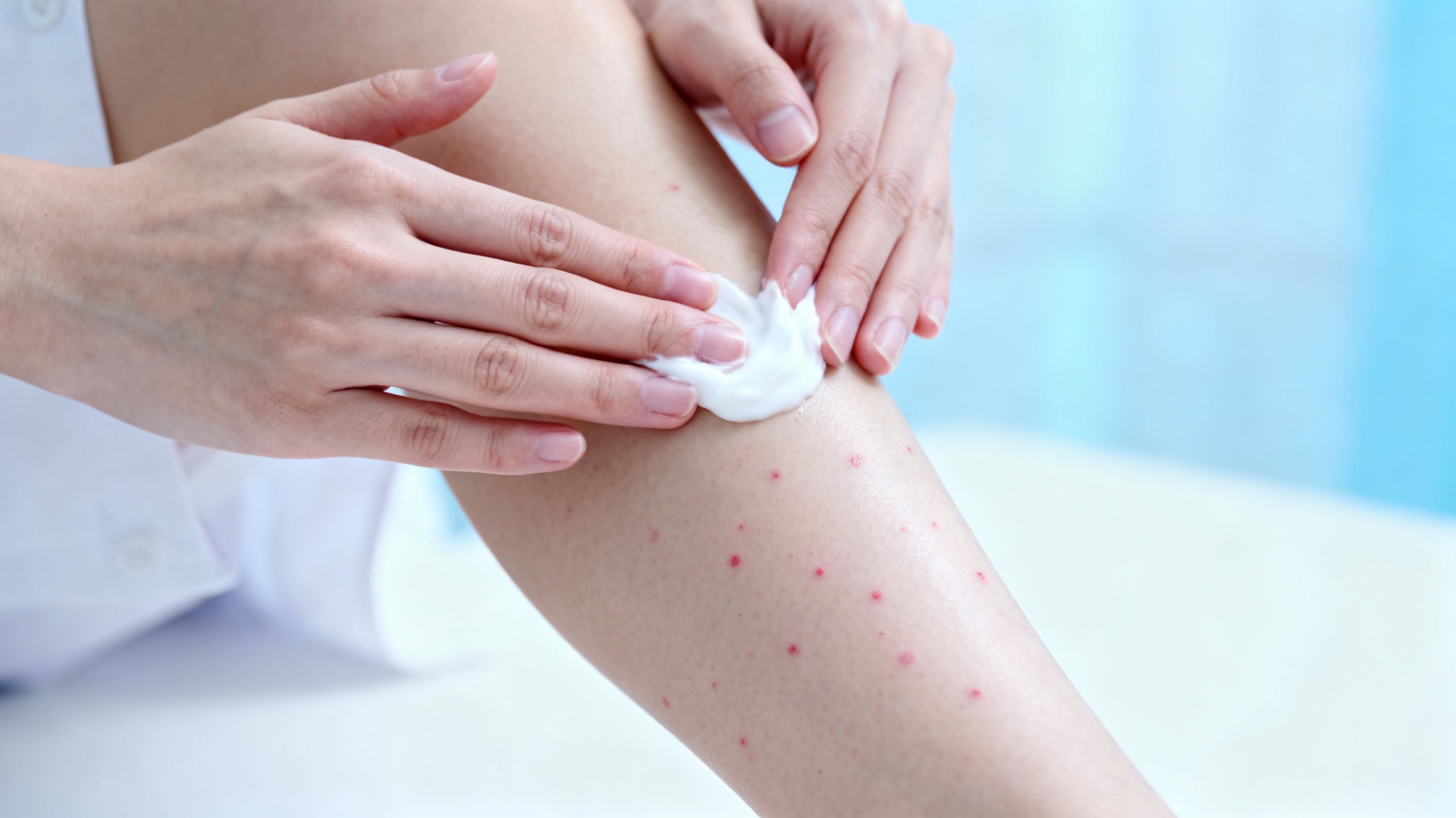 Featured image for Quelling the Rash: Best Practices for Chickenpox Rash Management